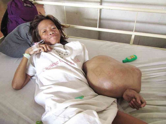 Caparas likens having a 20-kilogram tumor on her arm to carrying a child you can’t put down. CONTRIBUTED PHOTO
