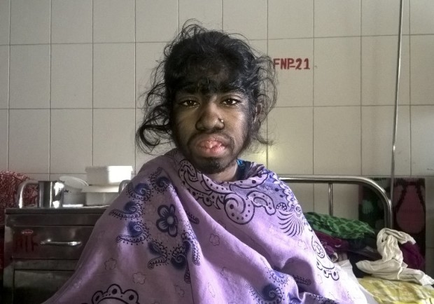 Bangladeshi patients Bithi Akhtar sits for a photograph as she waits in a ward at a hospital in Dhaka on May 12, 2016.  The family of a 12-year-old Bangladeshi girl who suffers from a rare condition that causes thick hair to cover her face and body have spoken out as they seek to fund surgery to give their daughter a chance at a normal life. Bithi Akhtar suffers from Byars-Jurkiewicz syndrome and a complication known as hypertrichosis -- dubbed "werewolf syndrome".  / AFP PHOTO / STR
