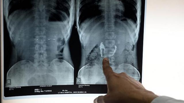 Lokmanya Tilak Medical College and Hospital dean Suleman Merchant pointing to an xray showing a necklace and pendant inside the stomach of alleged thief Anil Jhadav. Jhadav has been put on a special diet of bananas and special liquids by police to help him expel a stolen gold necklace. AFP