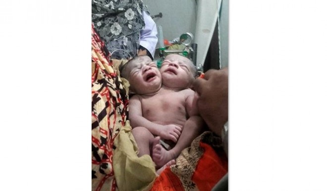 In this photograph taken on November 12, 2015, Bangladeshi conjoined twins receive medical care at a hospital in Brahmanbaria, some 120 kms east of Dhaka. Conjoined twin girls have died in Bangladesh less than a week after they were born, the hospital treating them said November 16. AFP PHOTO / STR / FILES