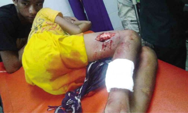 ONE of the children wounded allegedly when the Marines opened fire at houses in Maimbung, Sulu province. The children had been brought to the provincial hospital of Sulu.      DR. IKBALA’S FACEBOOK PAGE