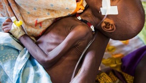 Sudan Malnourished Baby