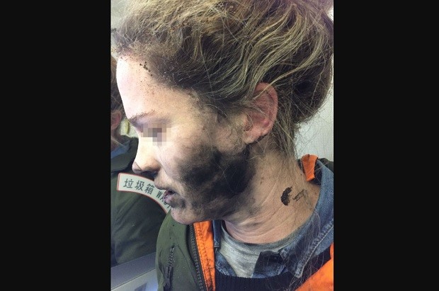 This photo from  Australian Transportation Safety Board website shows an unidentified woman who reportedly suffered injuries after the batteries of her headphone exploded and caught fire while on a flight from Beiing, China, to Melbourne, Australia. AUSTRALIAN TRANSPORTATION SAFETY BOARD PHOTO