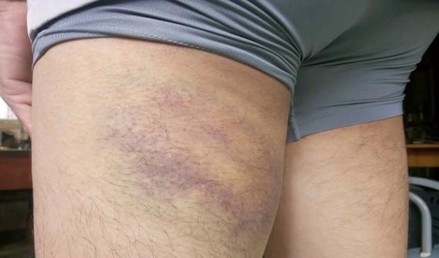 Jeffrey Sarabia bruised thigh - 23 Sept 2017