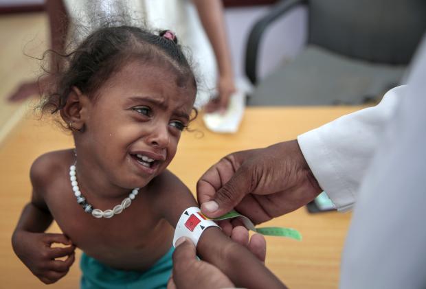 Malnourished girl in Yemen