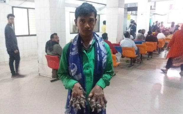 Bangladeshi 'Tree Man' dreams of cure as rare skin disease returns