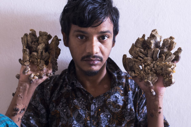 Bangladesh 'Tree Man' wants hands amputated to relieve pain