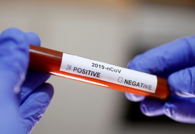The photo shows a test tube labeled coronavirus positive as the DOH reports 823 more people in the Philippines contract COVID-19 bringing nationwide active cases to 10,032