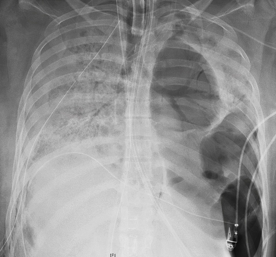 This X-ray image provided by Northwestern Medicine in June 2020 shows the chest of a COVID-19 patient before she received a new set of lungs because of severe lung damage from the coronavirus, at Northwestern Memorial Hospital in Chicago. (Northwestern Medicine via AP)