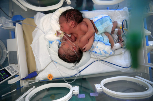 At-risk conjoined Yemeni twins need treatment abroad – hospital