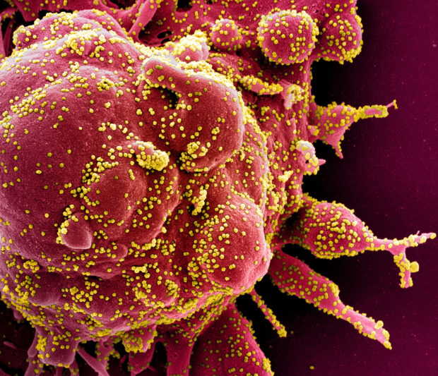 Colorized scanning electron micrograph of apoptotic cell infected with novel coronavirus