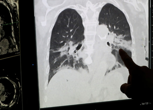 4DMedical lung imagery sheds more light on 'long COVID' effects