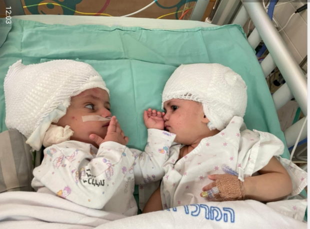 israel conjoined twins