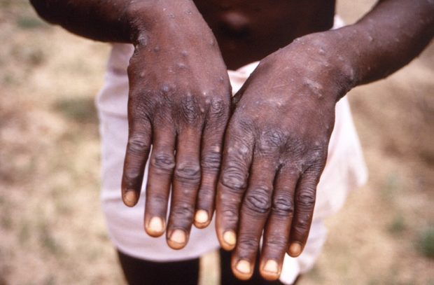 Hands of man showing symptoms of monkeypox. STORY: WHO wants monkeypox renamed; any suggestions?