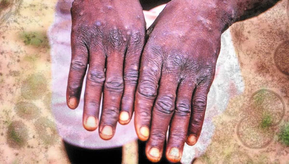 Experts: No need to be scared of monkeypox