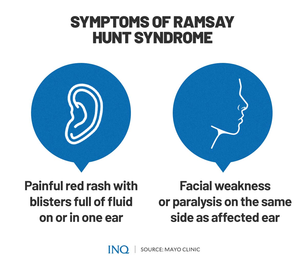 Syndrome De Ramsay Hunt