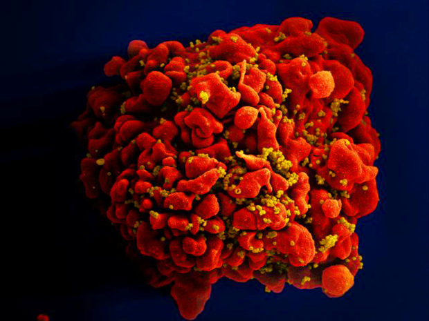 Oldest patient yet cured of HIV after stem cell transplant—researchers