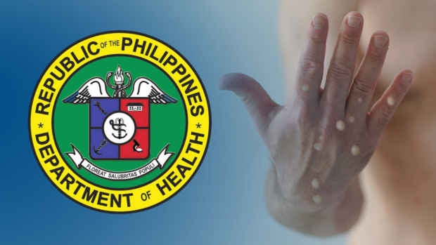 The DOH reports that the first monkeypox case in the Philippines has already recovered and may soon be discharged from isolation.