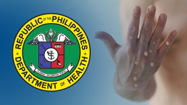 DOH logo with closeup of hand with monkeypox symptoms. STORY: PH still monkeypox-free amid WHO global alert