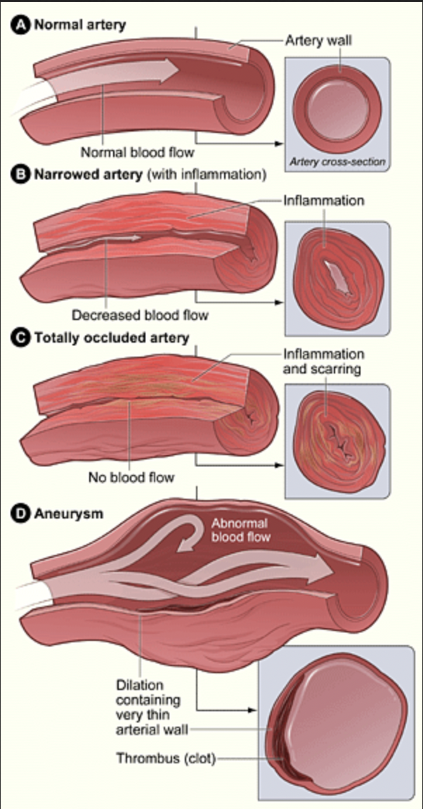 EFFECTS OF AN INFLAMMATION ON AN ARTERY. GRAPHIC: US NIH