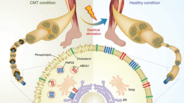 Scientists develop world's 1st therapy for Charcot-Marie-Tooth disease