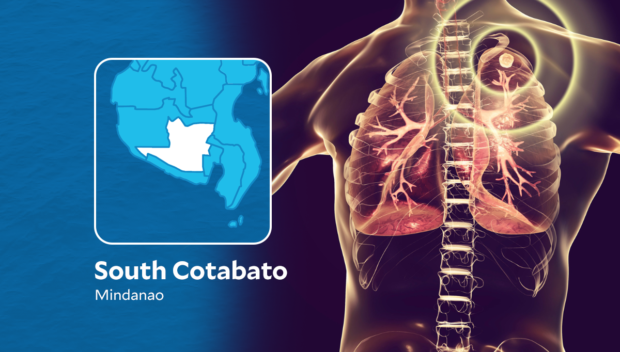 South Cotabato detects 810 cases of TB