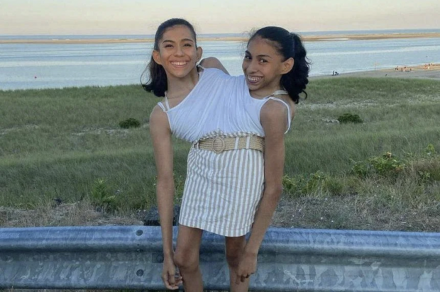 Conjoined twins Lupita and Carmen Andrade