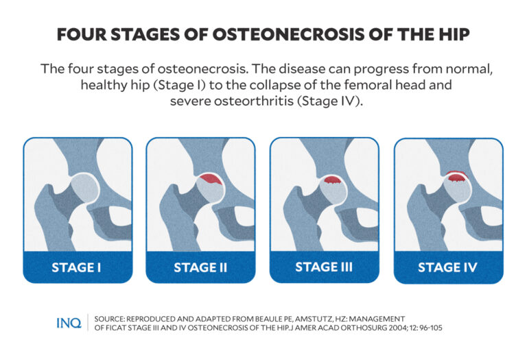 Osteonecrosis or 'bone death': What to know about Angelica Panganiban's ...