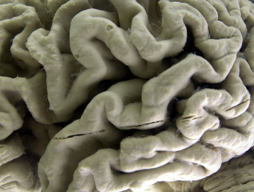 Silent brain changes precede Alzheimer's--study 