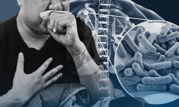 PHOTO: Composite image of man coughing wiht fist over mouth and an x-ray image showing detail of TB bacteria STORY: Fight against TB persists in PH as disease remains a threat