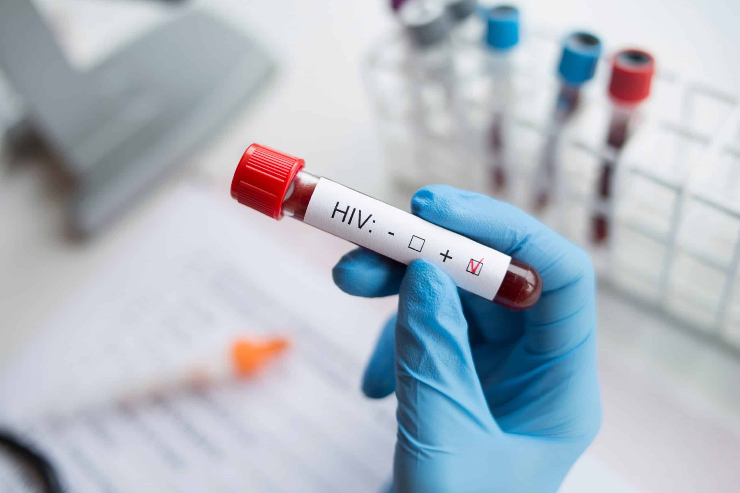 A 60-year-old German man is likely the seventh person to be effectively cured from HIV after receiving a stem cell transplant, doctors announced on Thursday.